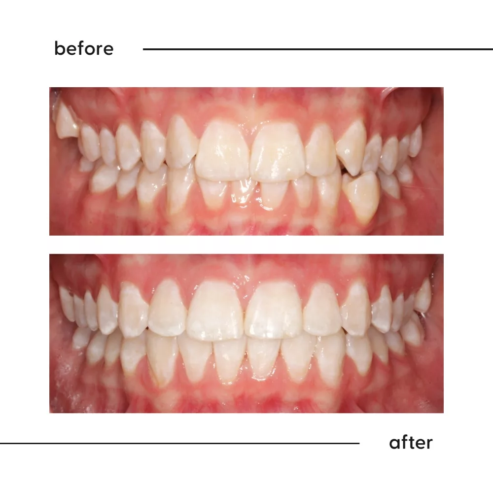 Before and after of mild crowding and small spaces finished into an even smile, Auckland