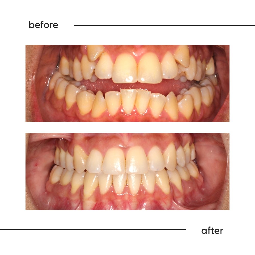 Before and after of an anterior open bite closed so the front teeth meet, Auckland orthodontics