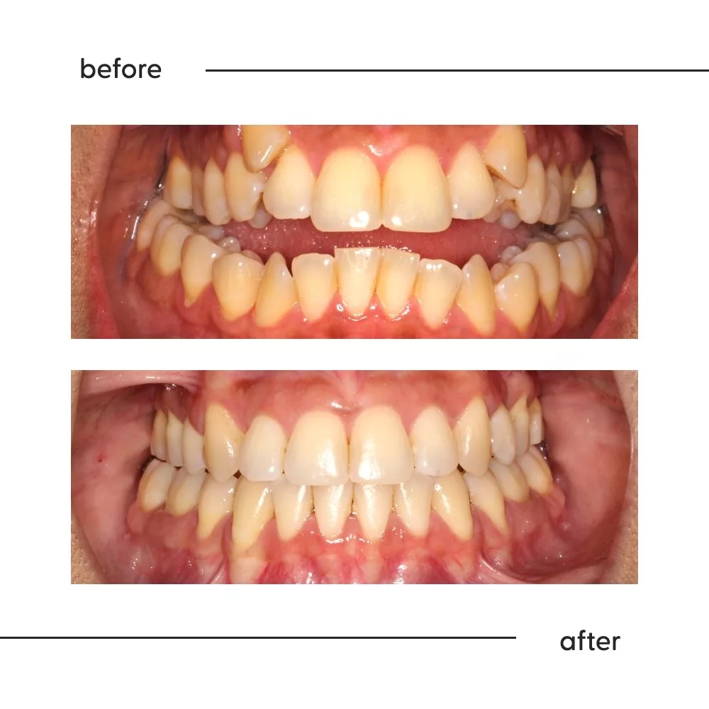 Before and after of an anterior open bite closed so the front teeth meet, Auckland orthodontics