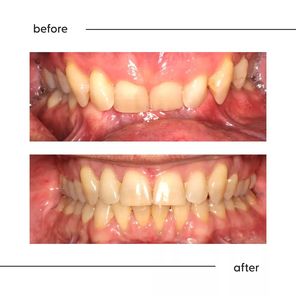 Before and after of a worn, uneven adult bite realigned by a specialist orthodontist in Auckland