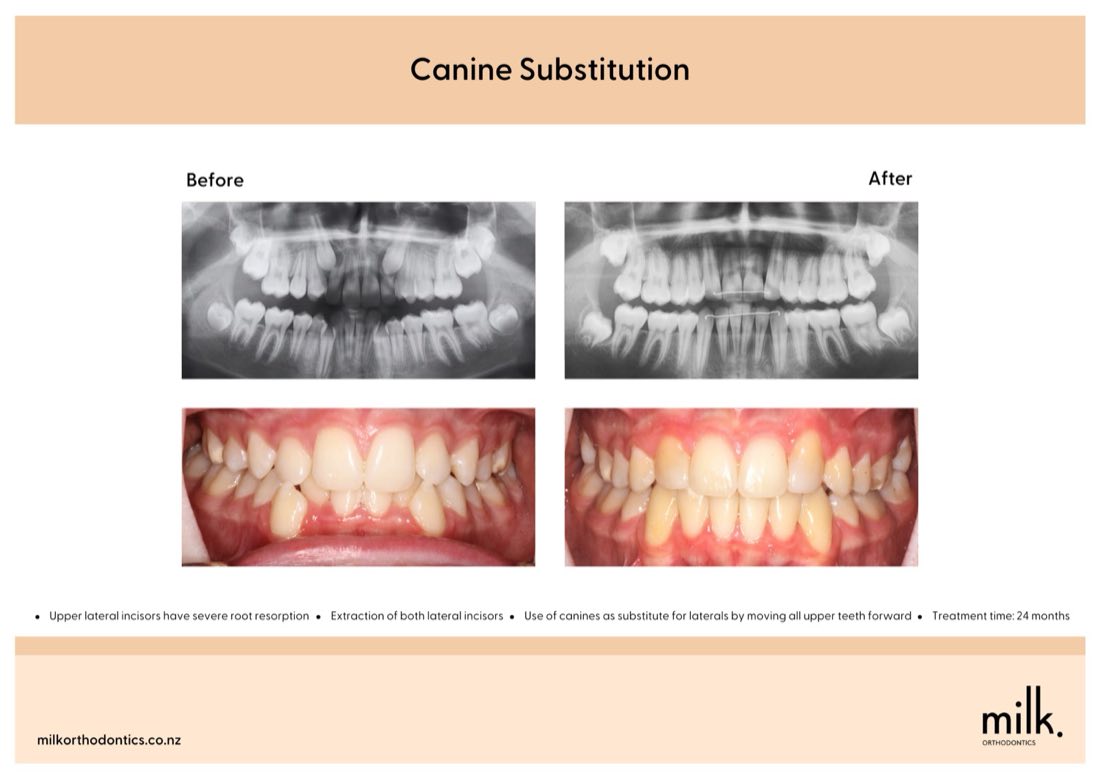 Before and after of missing upper side teeth treated with canine substitution in Auckland