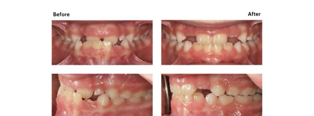 Before and after of a crossbite corrected at Milk Orthodontics, Auckland