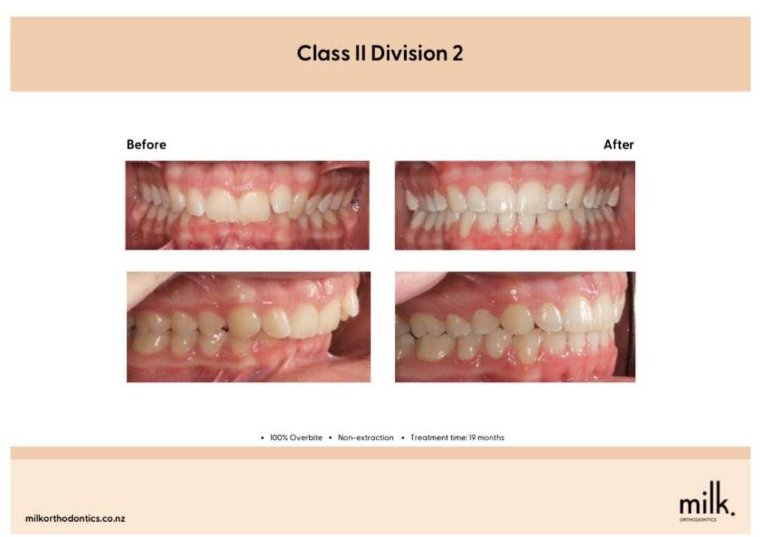 Before and after of a Class II division 2 deep bite corrected in Auckland