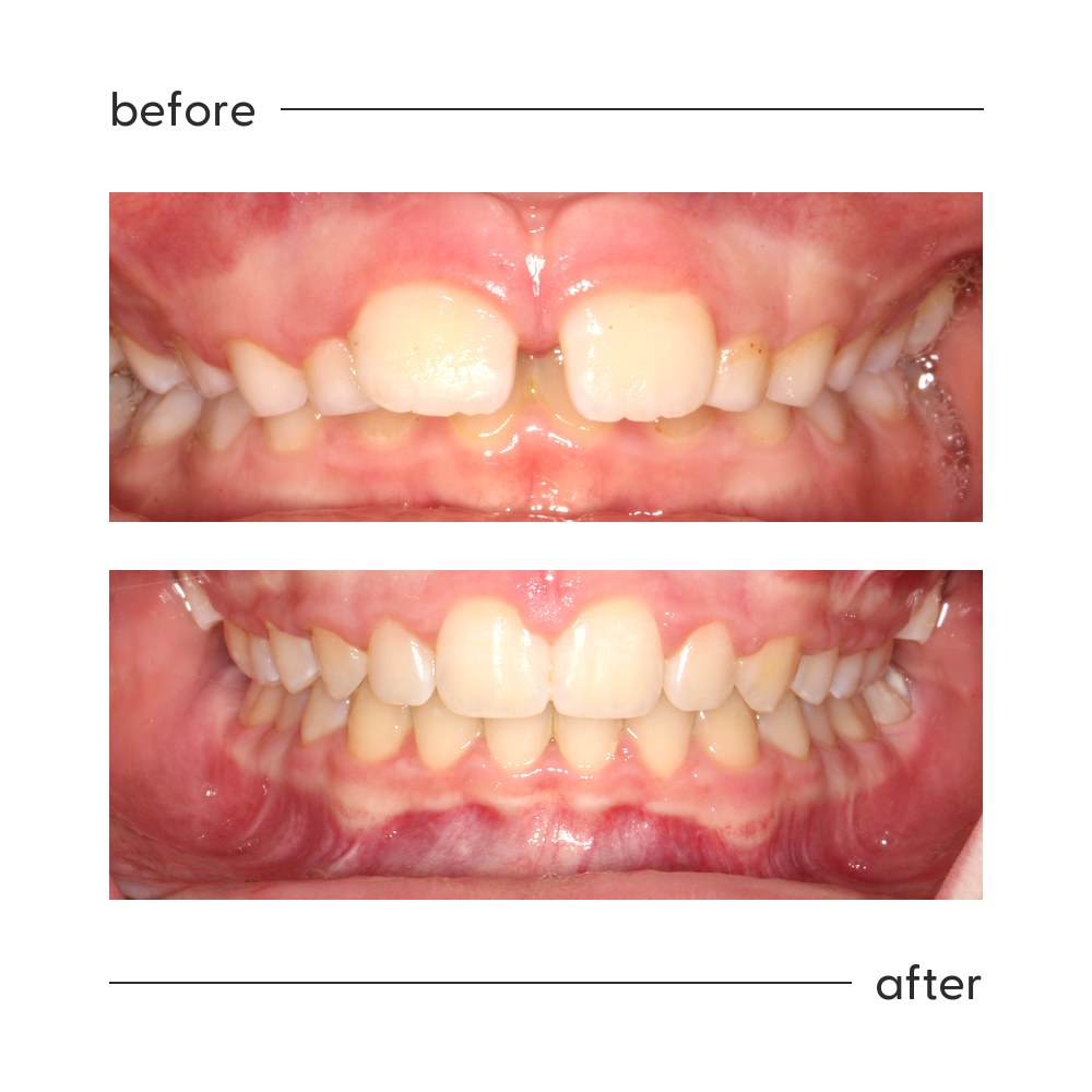 Before and after of a midline gap between the front teeth closed with orthodontic treatment in Auckland