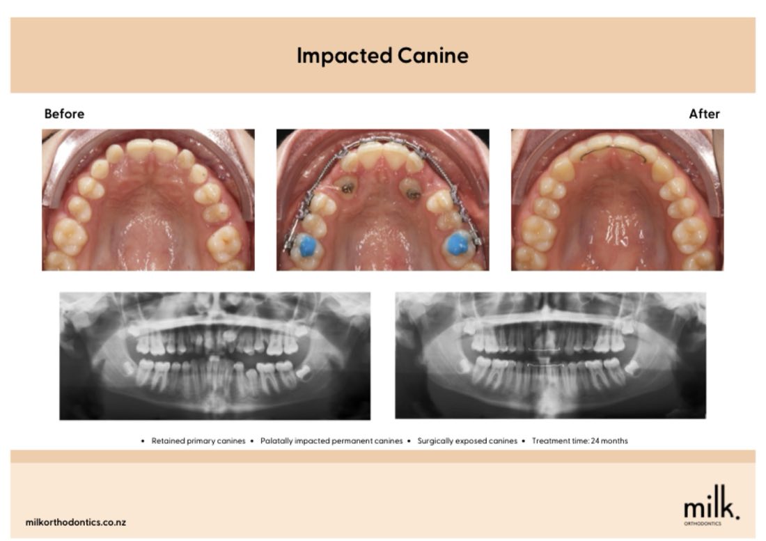 Before and after of impacted canines guided into the dental arch, Auckland specialist orthodontics