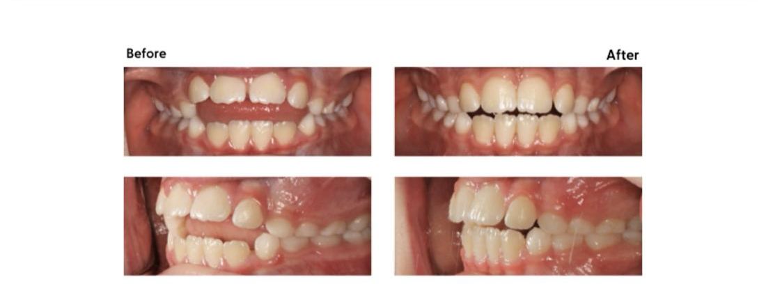 Before and after of an open bite corrected at Milk Orthodontics, Auckland