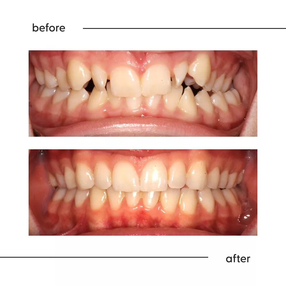 Before and after of crowding and a large overjet corrected, Auckland specialist orthodontic result