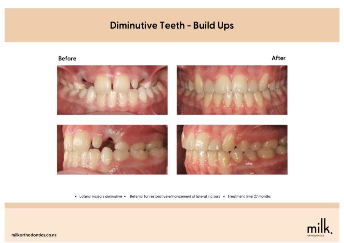 Before and after of small upper side teeth with the spaces closed, Auckland orthodontics