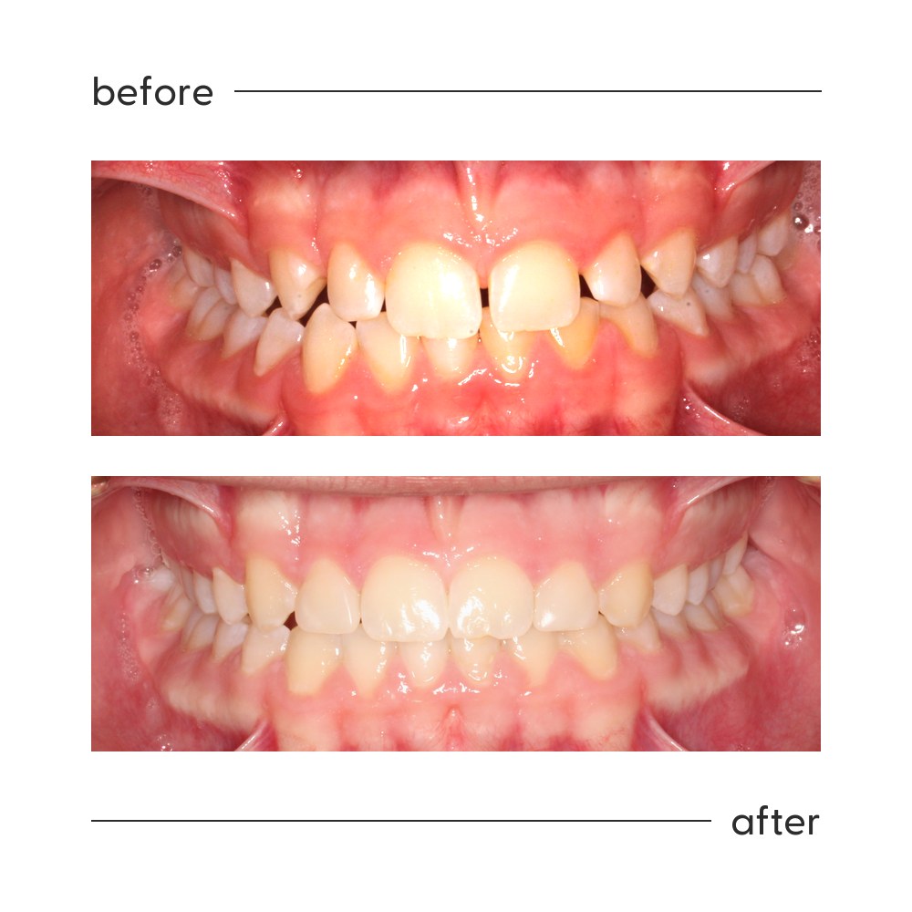 Before and after of spaces between the teeth closed with orthodontic treatment in Auckland