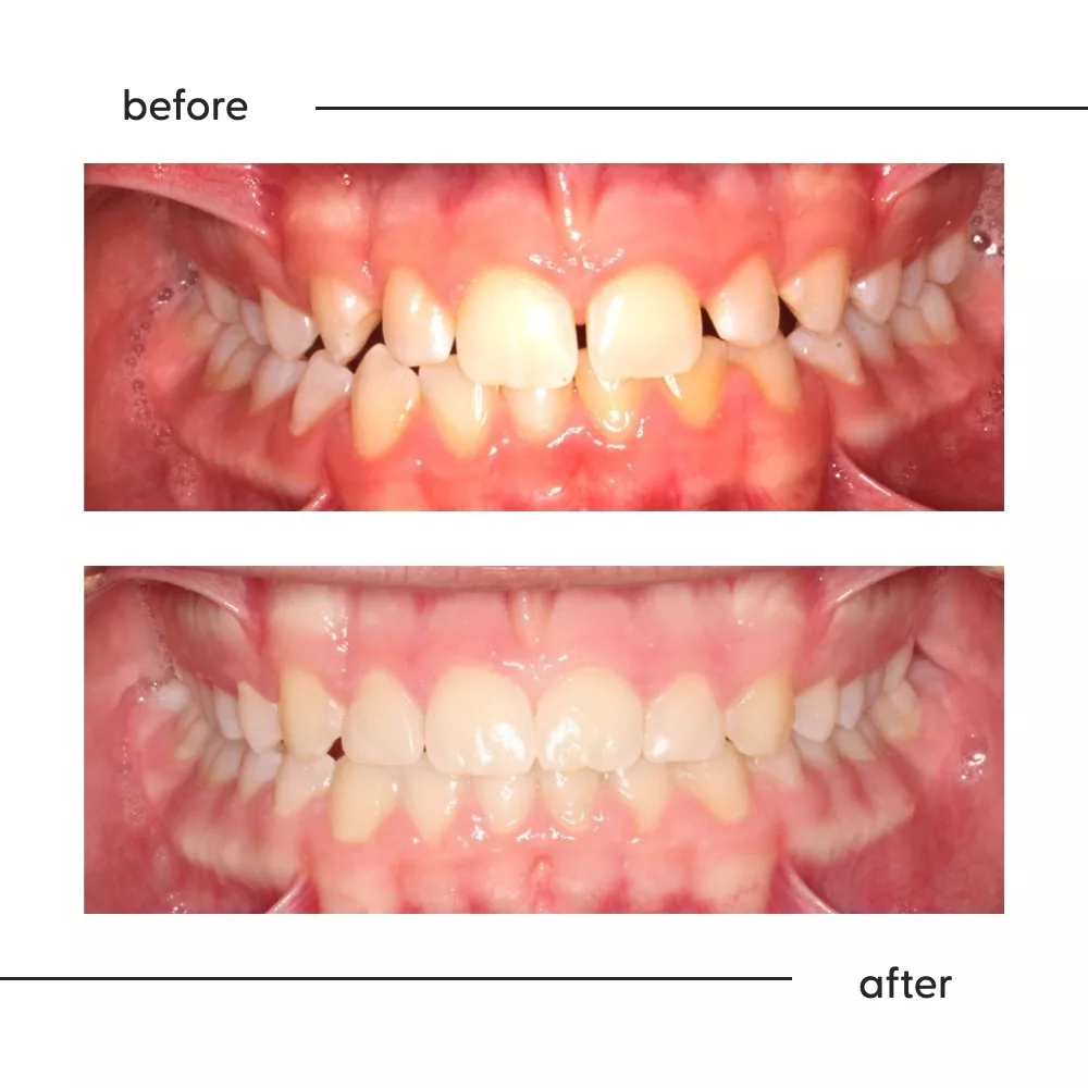 Before and after of spaces between the teeth closed with orthodontic treatment in Auckland