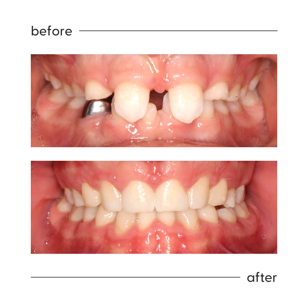 Before and after of spacing and a missing tooth managed into an even smile, Auckland orthodontics
