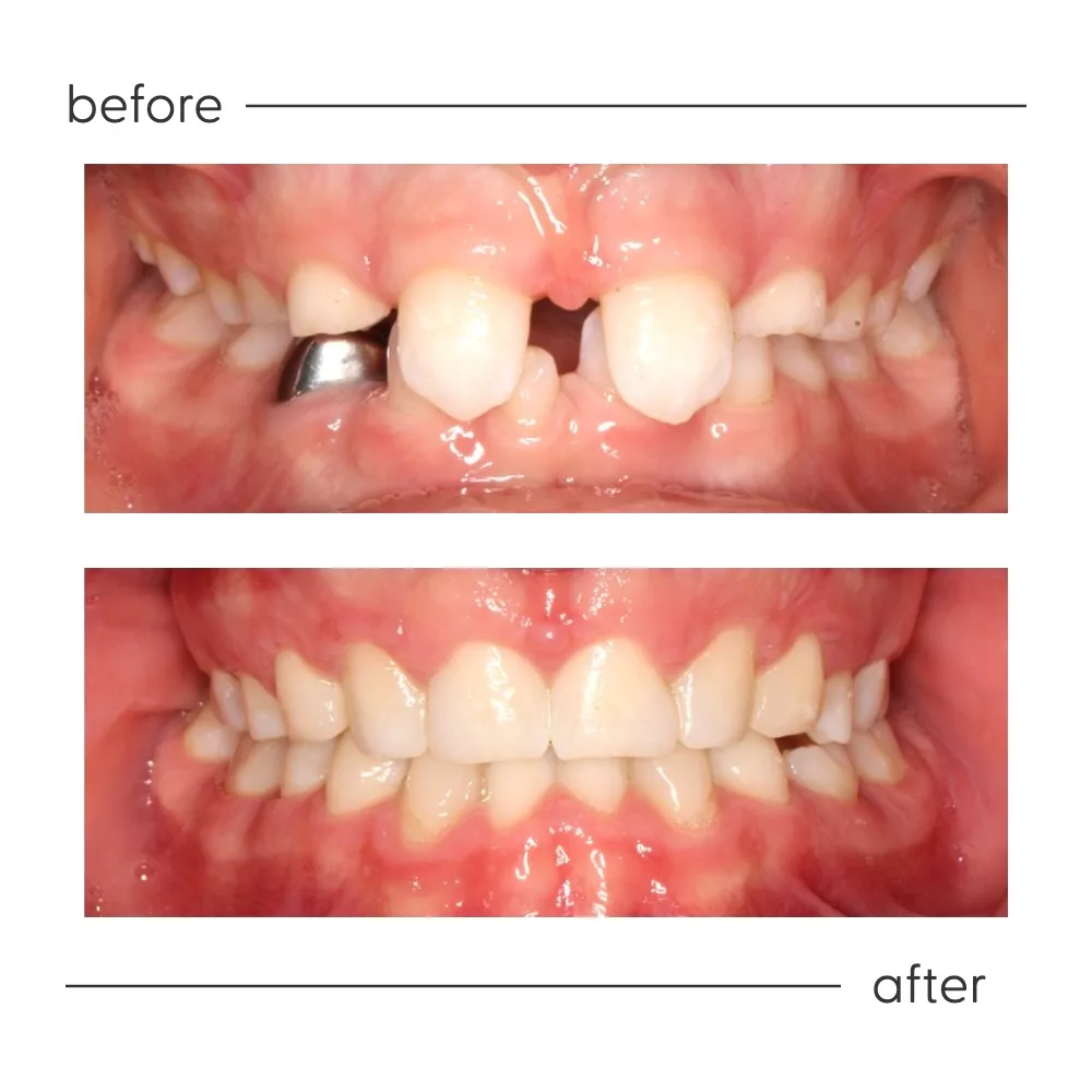 Before and after of missing teeth treated at Milk Orthodontics, Auckland
