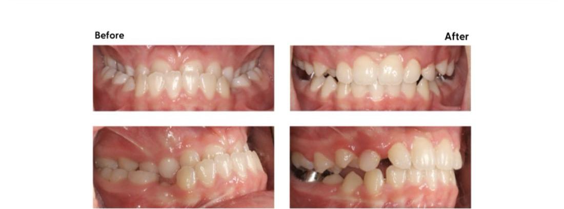Before and after treatment of a Class III underbite at Milk Orthodontics, Auckland
