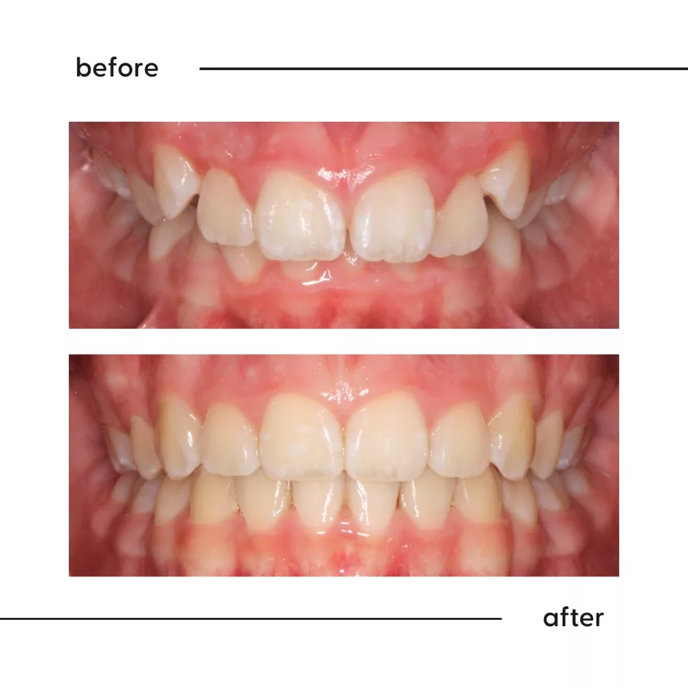 Before and after of crowded front teeth and a deep bite corrected by a specialist orthodontist