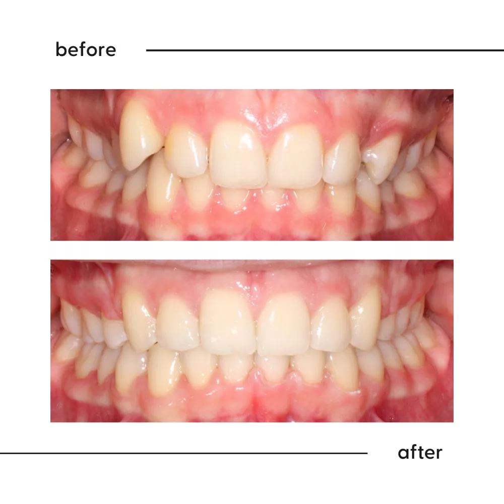 Before and after of severe crowding with a rotated side tooth and high canine, straightened in Auckland