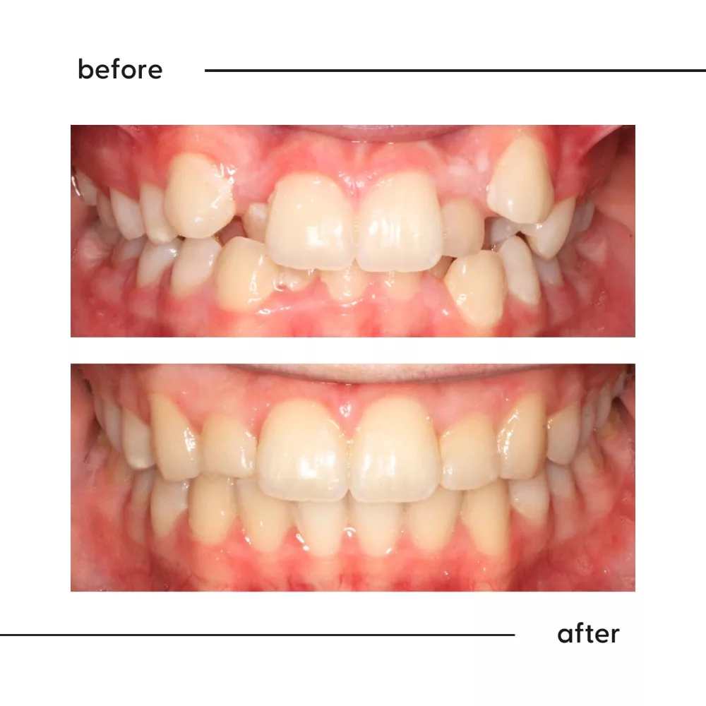 Before and after of severe crowding with a displaced side tooth straightened in Auckland