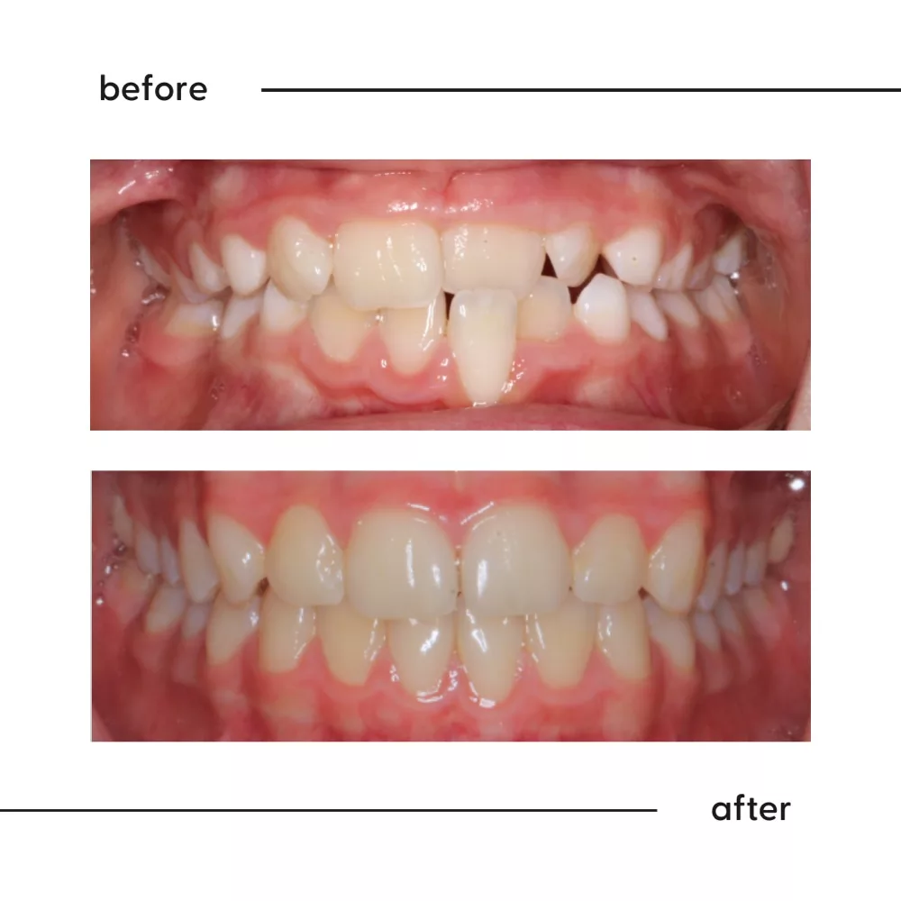 Before and after of severely crowded teeth straightened by a specialist orthodontist in Auckland