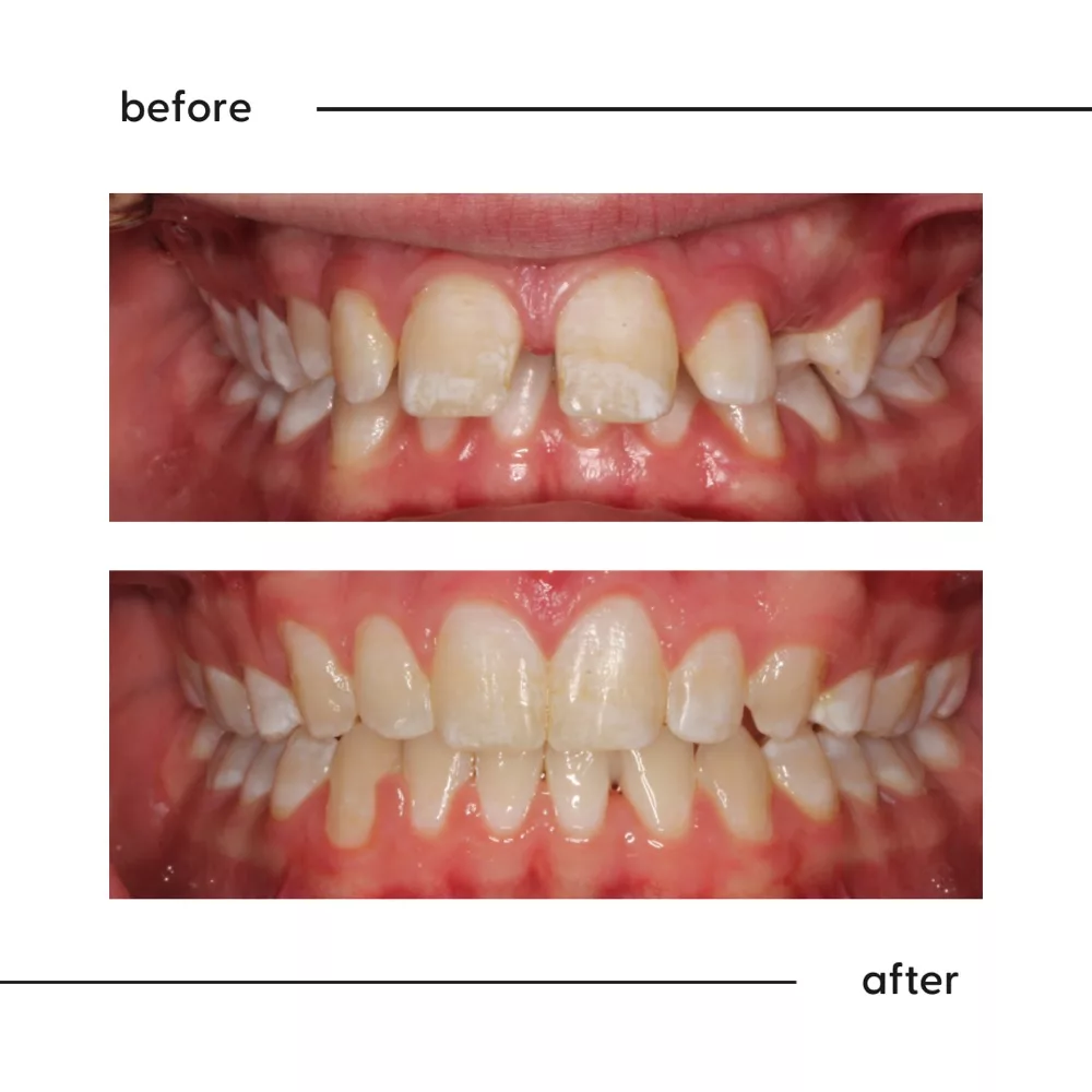 Before and after of a wide gap between front teeth closed with orthodontic treatment in Auckland